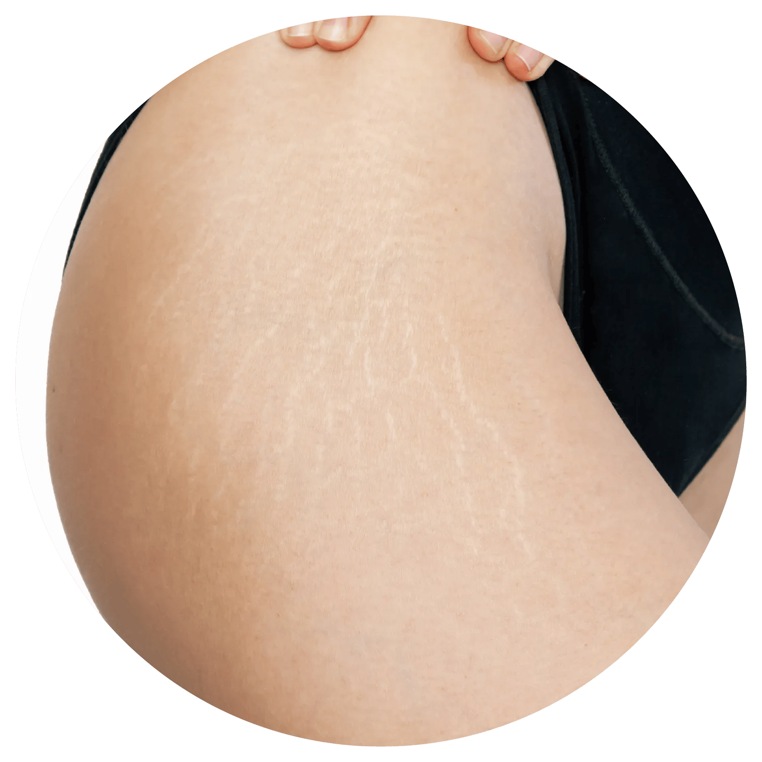 Stretch Marks treatment results at Toronto medical spa - The Chain Reaction of Symptoms